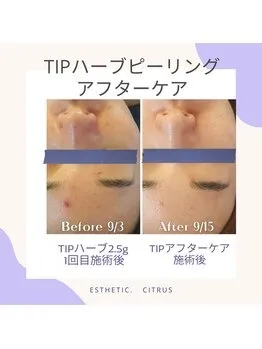 TIPハーブピーリング 2.5g